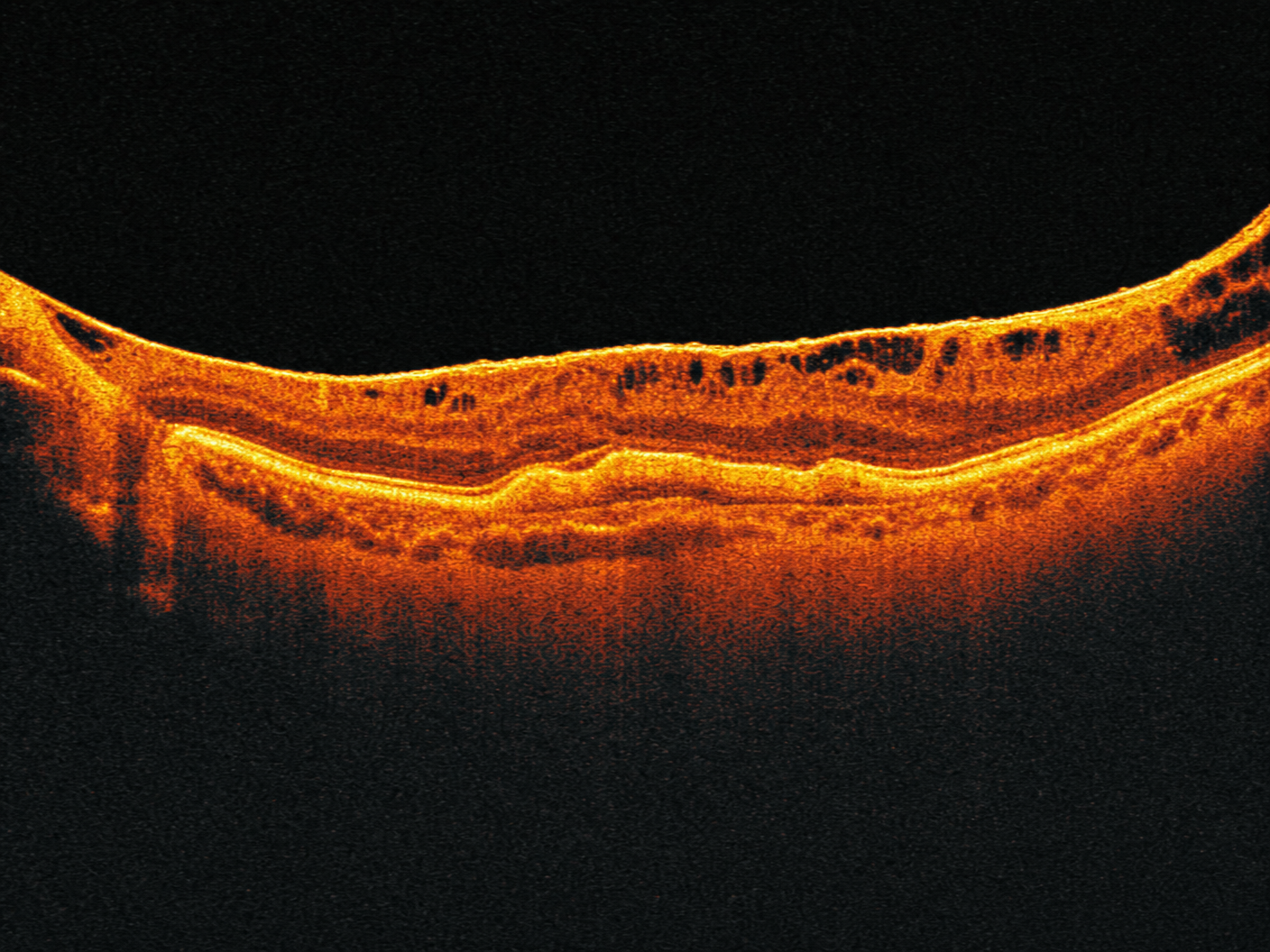 epiretinal membrane