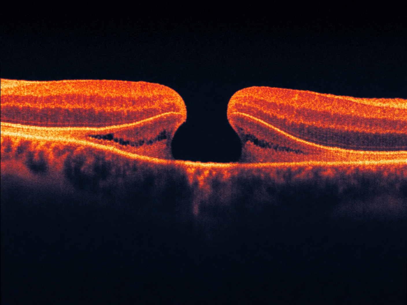 macular hole