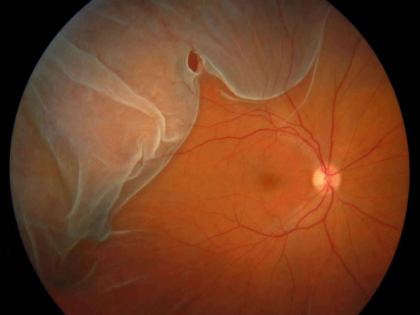 floaters flashes retinal detachment