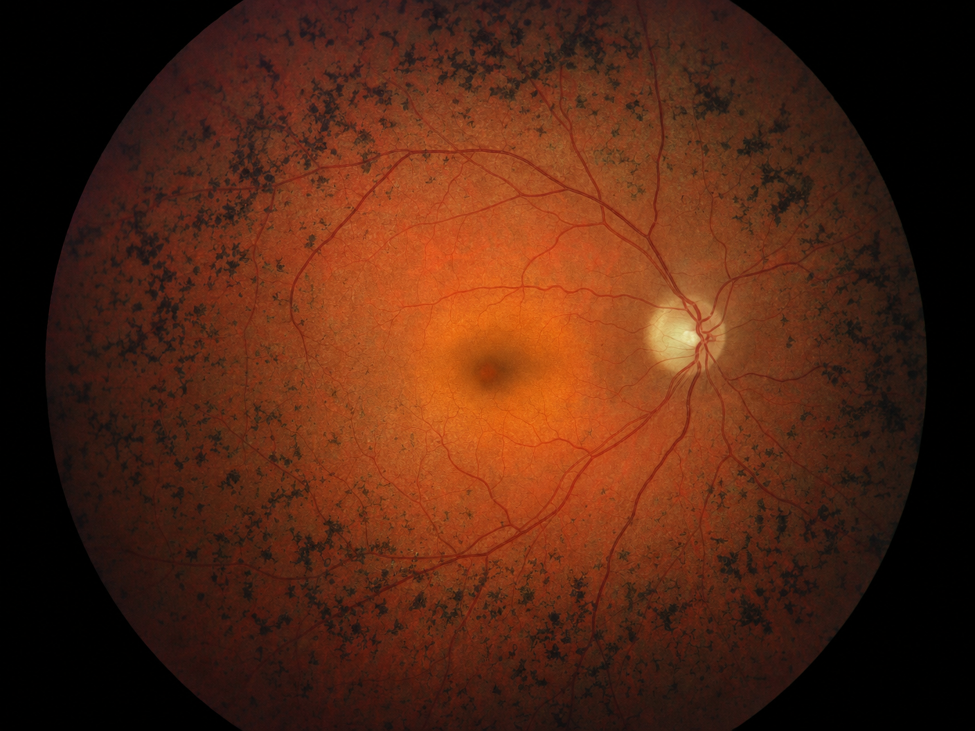 retinitis pigmentosa
