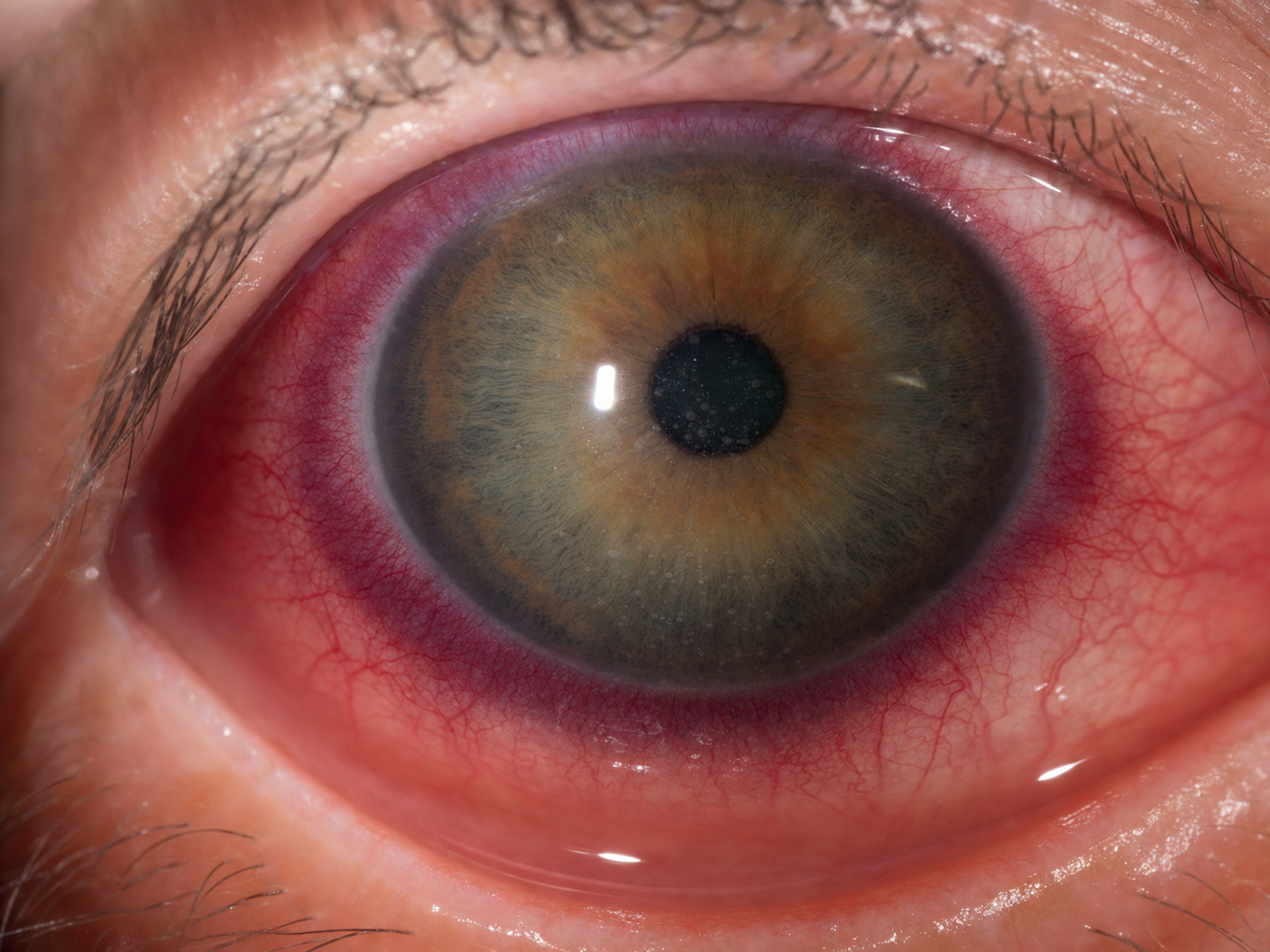 uveitis