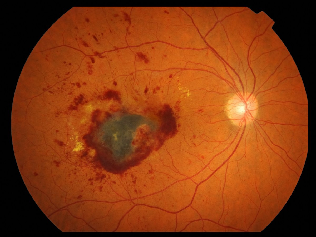 Wet AMD fundus photograph showing subretinal fluid and choroidal neovascularisation